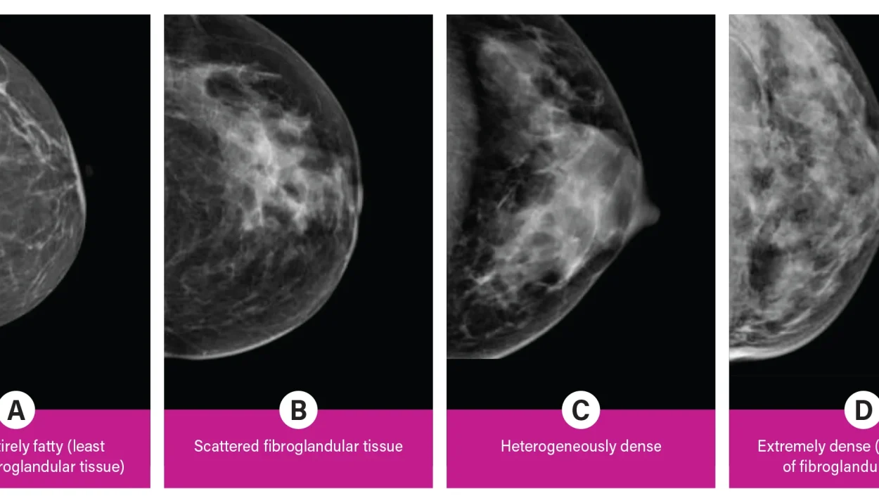 Breast Density