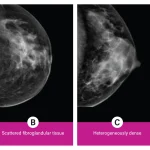 Breast Density