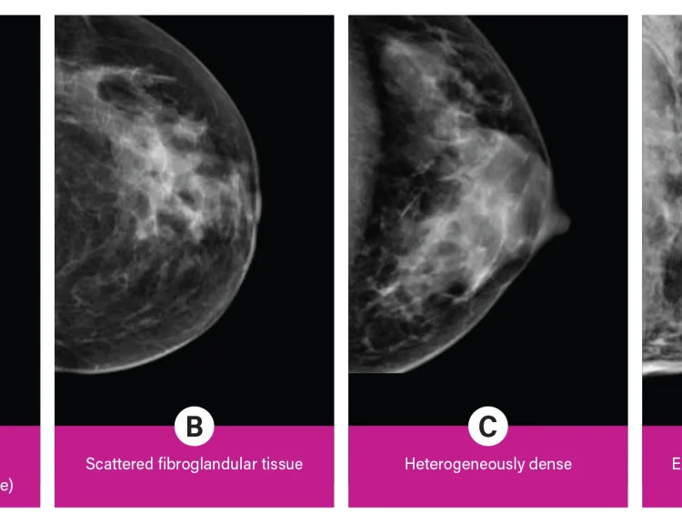 Breast Density